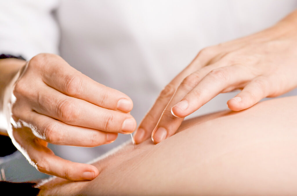 akupunktur